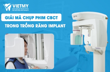 Giải Mã Chụp Phim CBCT Trong Điều Trị Trồng Răng Implant